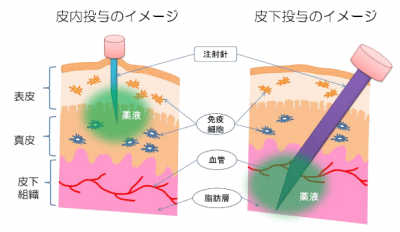 針刺し時の痛みが少ない皮内投与型インフルエンザワクチンの開発決定